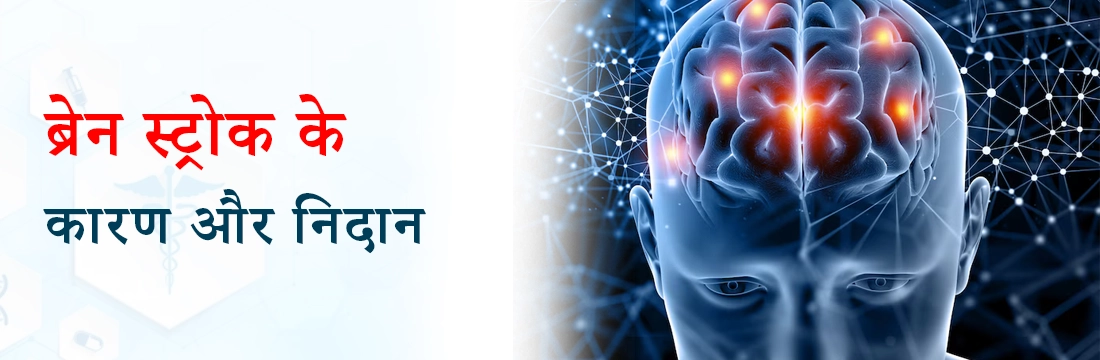  ब्रेन स्ट्रोक के कारण और निदान | Causes and Diagnosis of Brain Stroke in Hindi